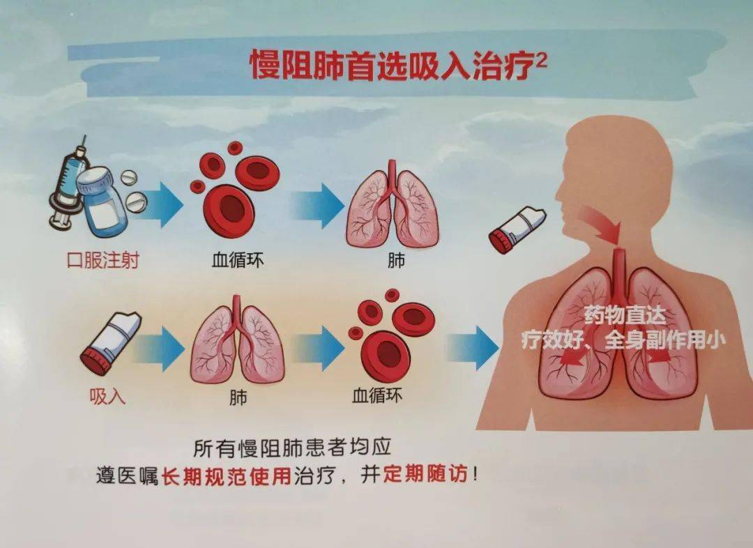 逆转慢阻肺最新技术，重塑呼吸自由的新希望之光