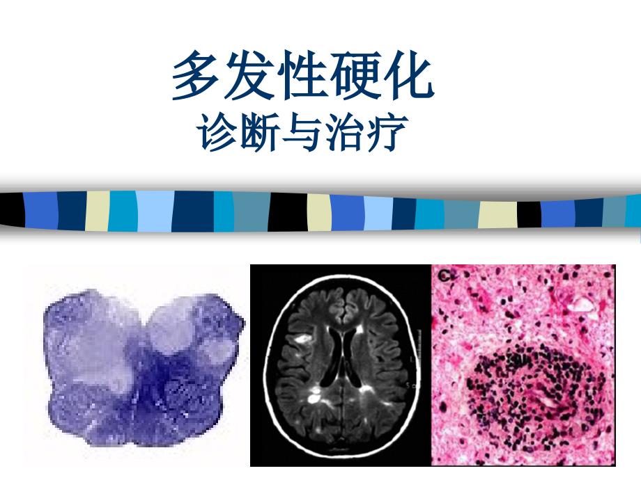 多发性硬化新疗法突破，带来治疗的新希望